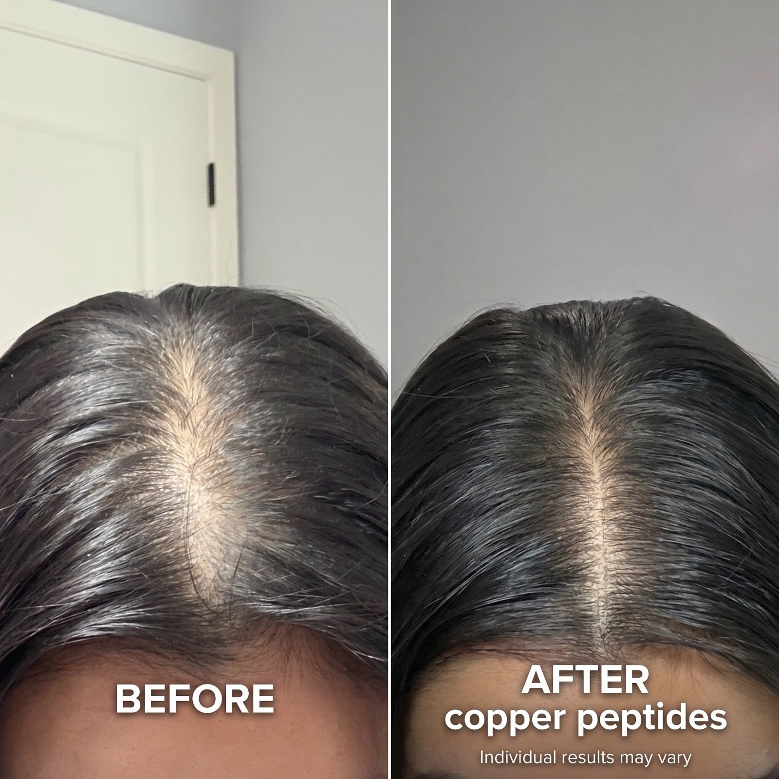 Micro-Infusion Peptide Regrowth System For Women