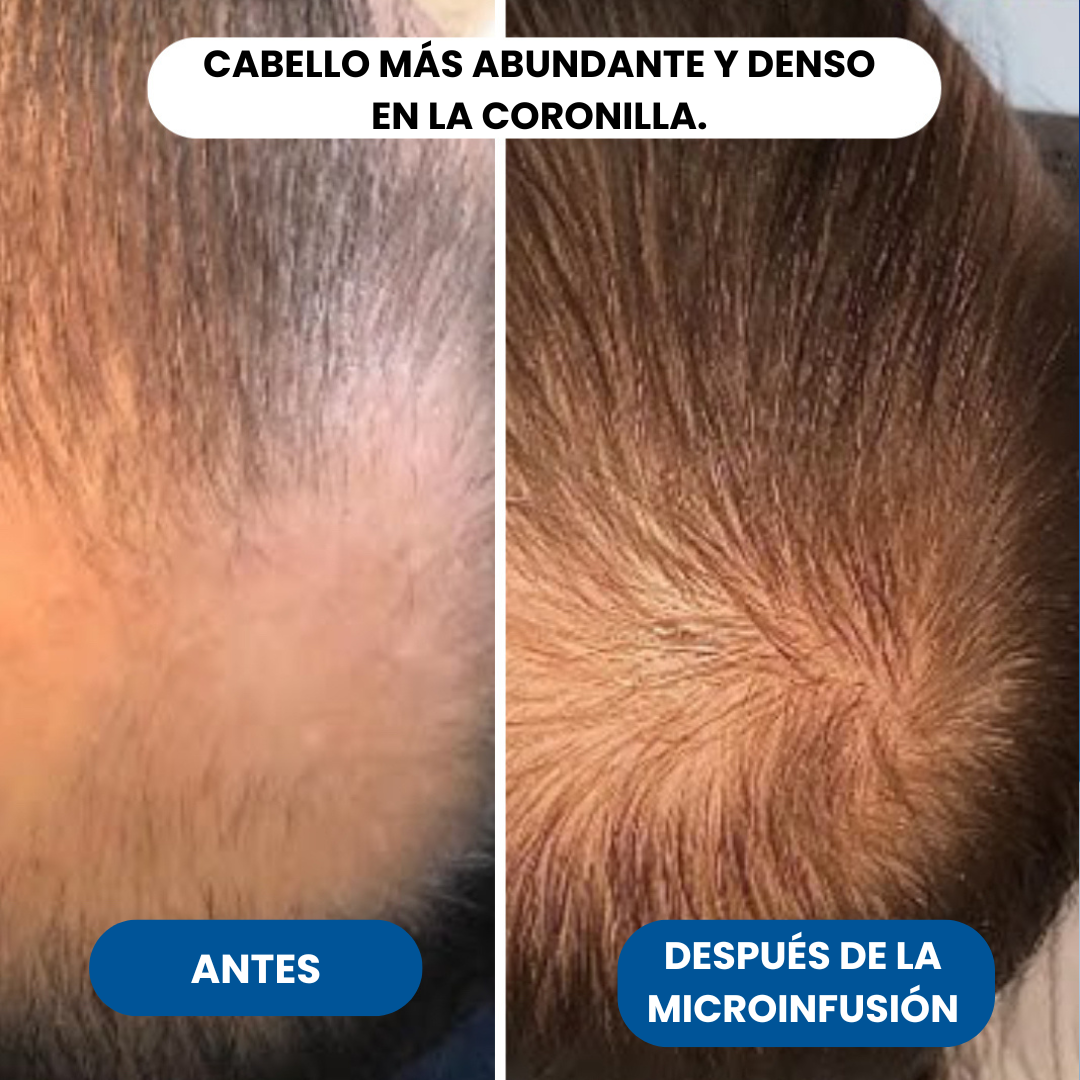 Microinfusión de péptidos para el crecimiento del cabello.
