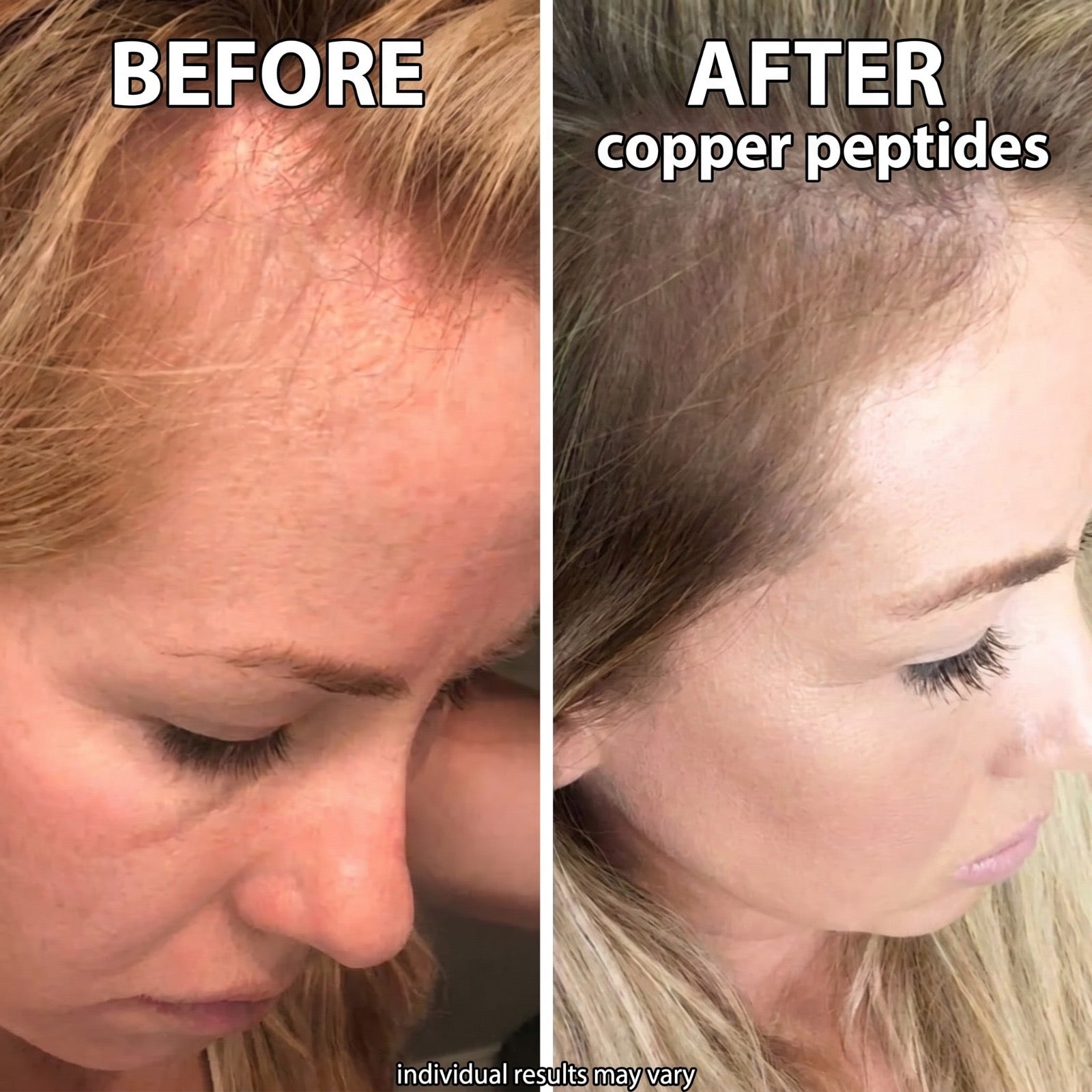 Micro-Infusion Peptide Regrowth System For Women